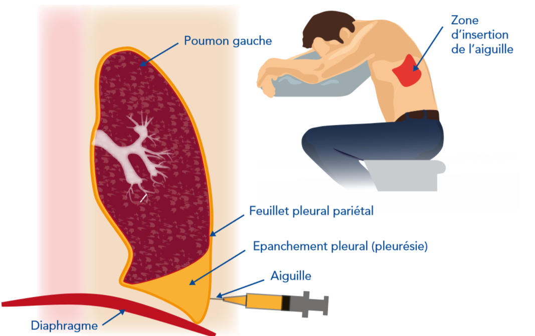 Ponction pleurale Arrad Anas
