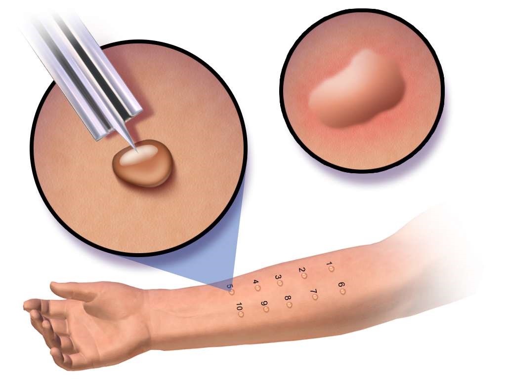 Pricks tests pneumologue Arrad Anas