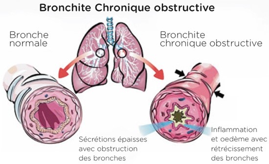 bpco Arrad pneumologue