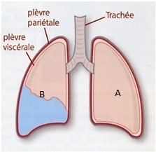 pleurésie Arrad Anas